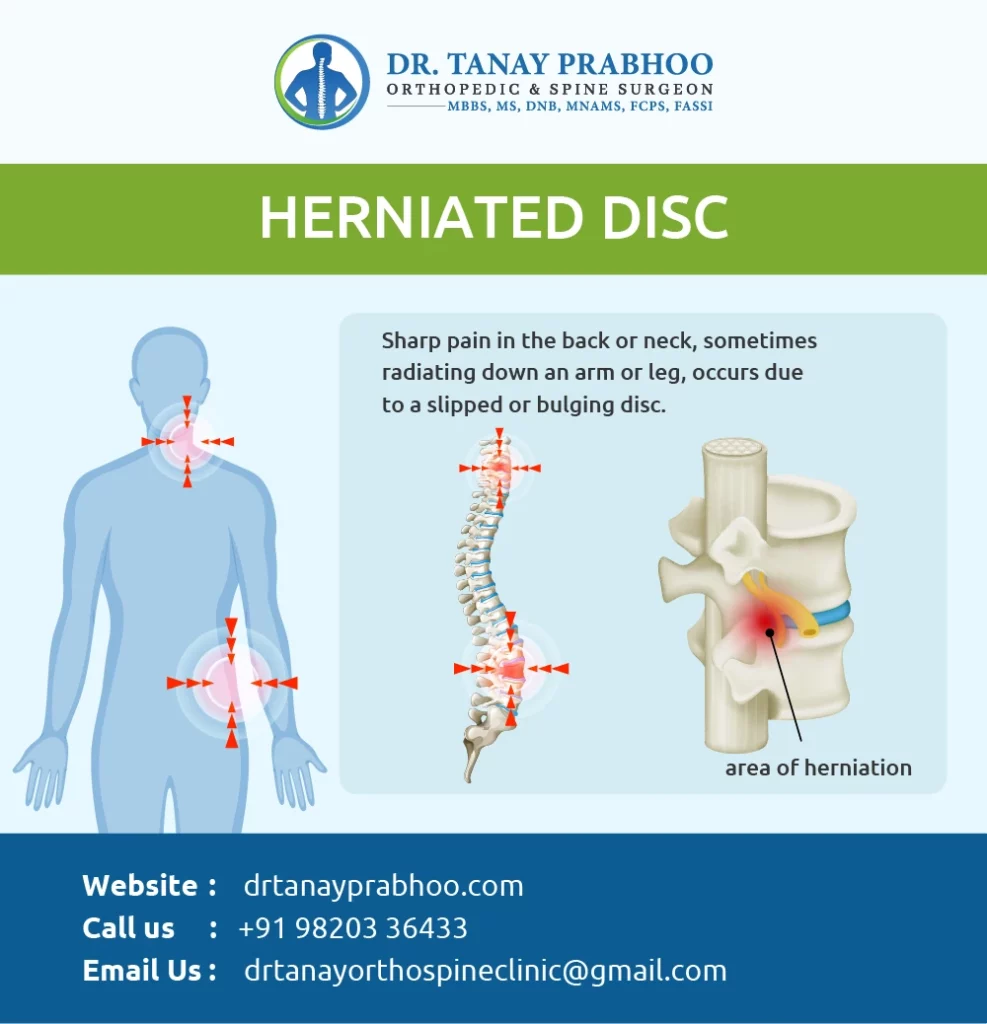 Infographic Herniated Disc